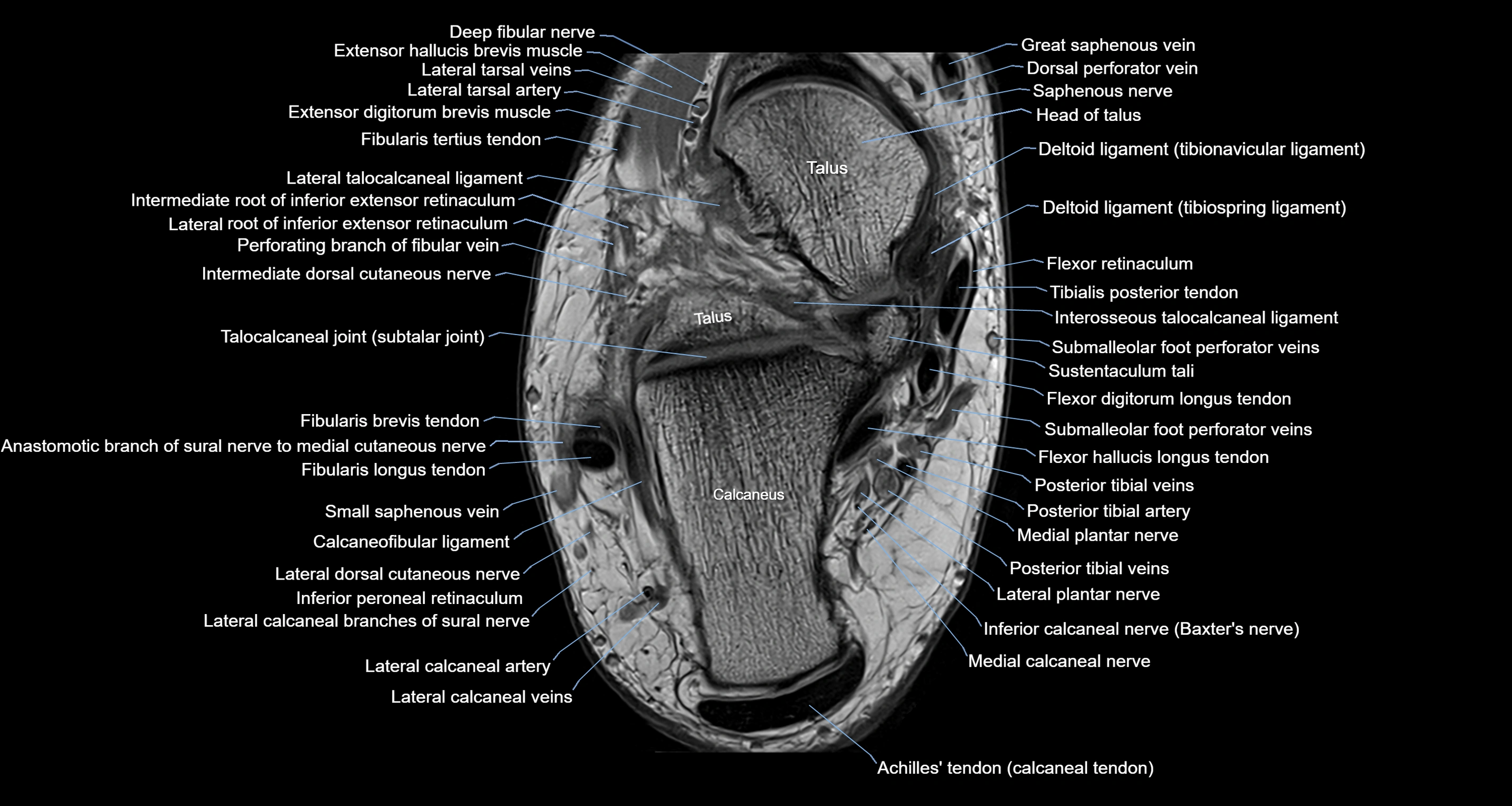 Ankle axial anatomy 3T MRI images -img-10001-00023.webp